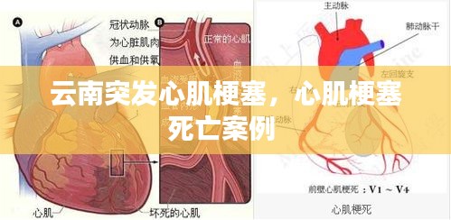 云南突發(fā)心肌梗塞，心肌梗塞死亡案例 