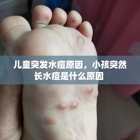 兒童突發(fā)水痘原因，小孩突然長水痘是什么原因 