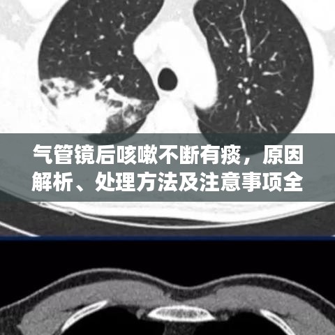 氣管鏡后咳嗽不斷有痰，原因解析、處理方法及注意事項全攻略