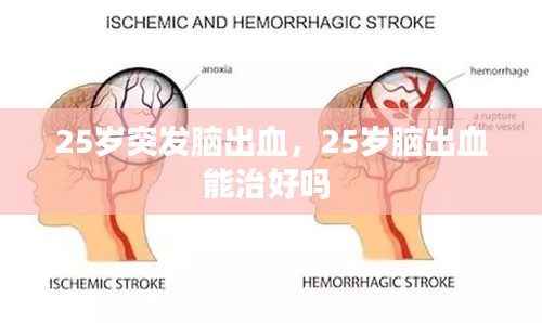 25歲突發(fā)腦出血，25歲腦出血能治好嗎 