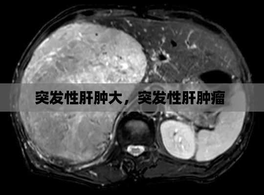 突發(fā)性肝腫大，突發(fā)性肝腫瘤 